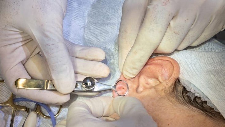 Lobuloplastia: o que é, para que serve e quando é indicada